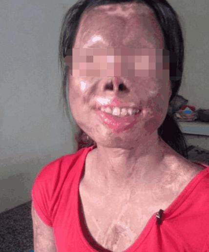 遭飞来石头砸脸毁容非常遗憾听到您遭遇飞来石头砸脸毁容的不幸事件。这种情况可能会给您带来身体和心理上的创伤，需要及时寻求医疗帮助和心理支持。